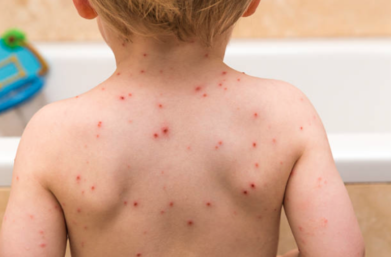 enfant varicelle boutons maladie