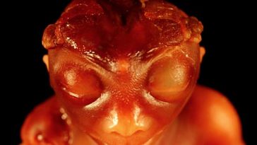 bébé sans crâne anencéphalie
