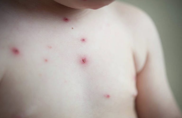 bébé enfant varicelle boutons