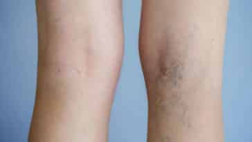 jambes femmes varices veines