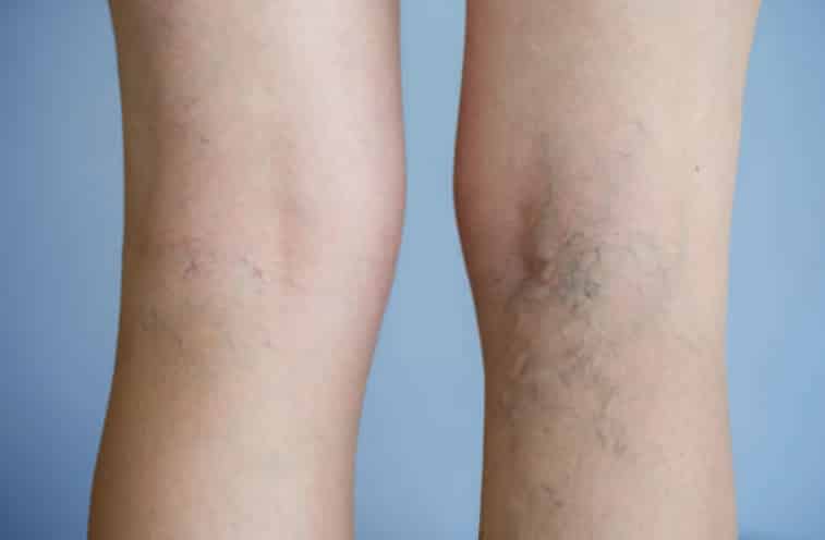 jambes femmes varices veines