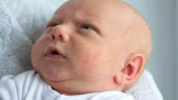 bébé acné du nourrisson nouveau-né peau boutons irritation