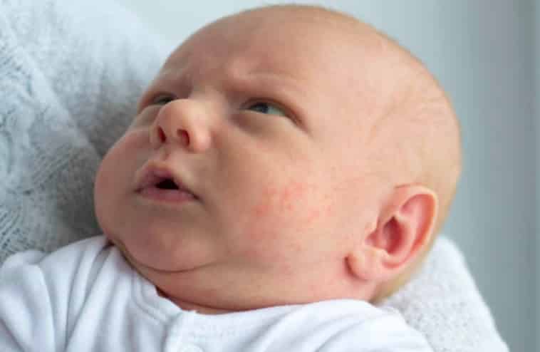 bébé acné du nourrisson nouveau-né peau boutons irritation