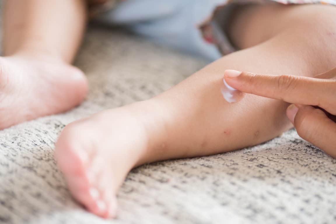 enfant bébé piqûre insecte moustique démangeaisons pieds enfant