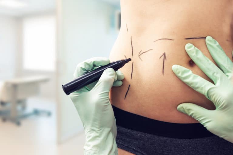 ventre abdominoplastie accouchement prise de poids chirurgie esthétique liposuccion