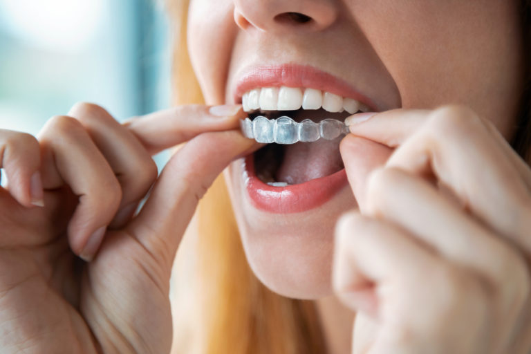 orthodontie traitement dents bagues appareil dentaire
